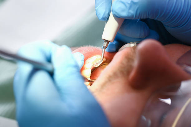 Best Emergency Root Canal Therapy in Deerfield, MI